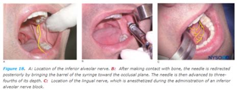 Mandibular Injections Penetration Site Flashcards Quizlet