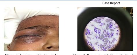 Pdf Chloroma Of The Orbit As A Presenting Feature Of Acute Myeloid