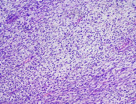 Fibrosarcoma Spindle Shaped Fibroblast Cells Arranged In Intersected