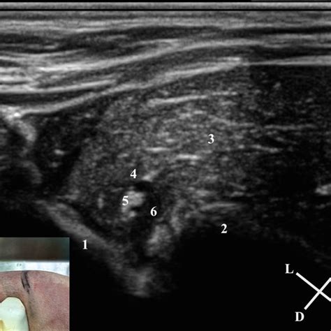 Ultrasonographic Landmarks For The Psoas Compartment 1 Transverse