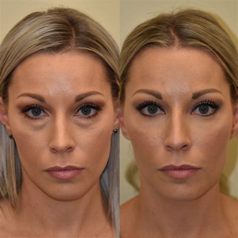 Lower Blepharoplasty Gone Wrong