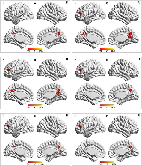 Frontiers Altered Dynamic Spontaneous Neural Activity In Minimal