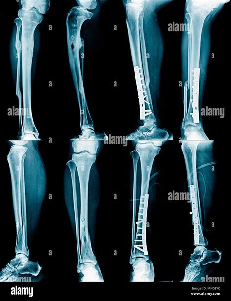 Broken Leg Xray High Resolution Stock Photography and Images - Alamy