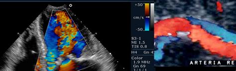 Ecografía Doppler de pene Dr J Romero