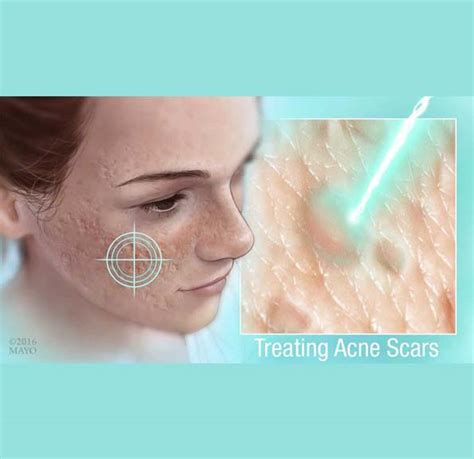 Acne Scars Treatment Singapore At Diane Weathersby Blog