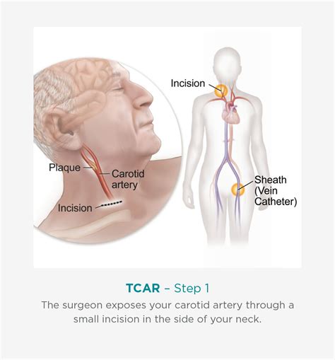 Carotid Intervention TCAR Procedure Benefits Recovery