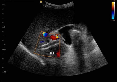 Transjugular Intrahepatic Portosystemic Shunt Ultrasound Evaluation