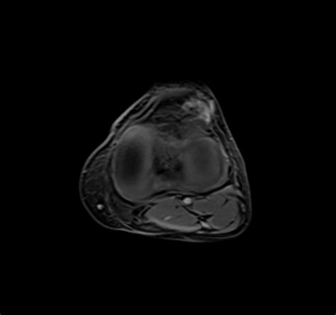 Infrapatellar Fat Pad Hemangioma Image