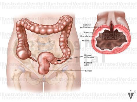 Stock Colon Perforation — Illustrated Verdict