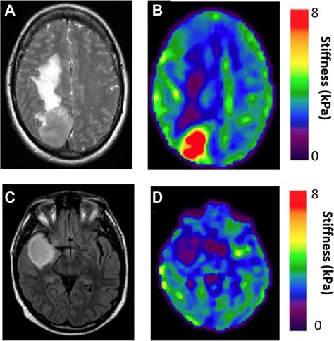 Magnetic Resonance Elastography Of The Brain Magnetic Resonance