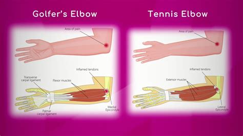 Golfers Elbow Vs Tennis Elbow Youtube