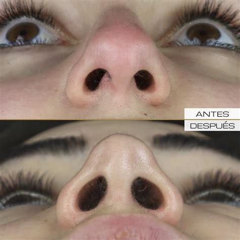 Rinoplastia Abierta Dr Ram N Terr