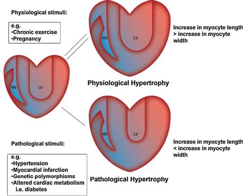 Figure 1 From Molecular Regulation Of Cardiac Hypertrophy Semantic