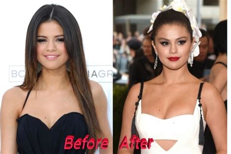 Selena Gomez Nose Job Plastic Surgery, Really?