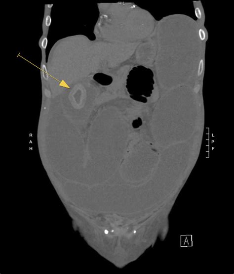 Recurrent Small Bowel Obstruction With Intraluminal Structur