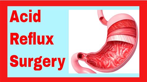 Most Common Acid Reflux Surgery With Quick Recovery CLASSICAL UPDATE