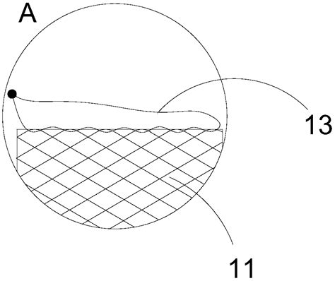 Tracheal Stent Patented Technology Retrieval Search Results Eureka