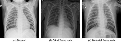 Examples Of Chest X Rays In Chestxray2017 The Normal Viral Pneumonia Download Scientific