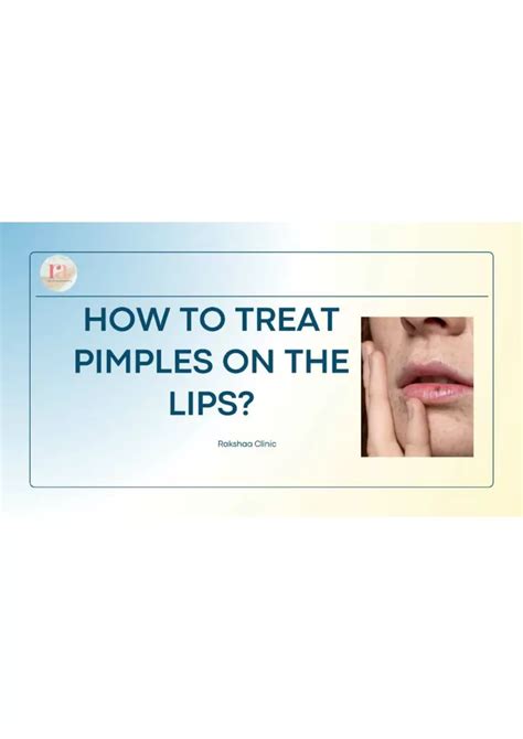 Ppt How To Treat Pimples On The Lips Powerpoint Presentation Free