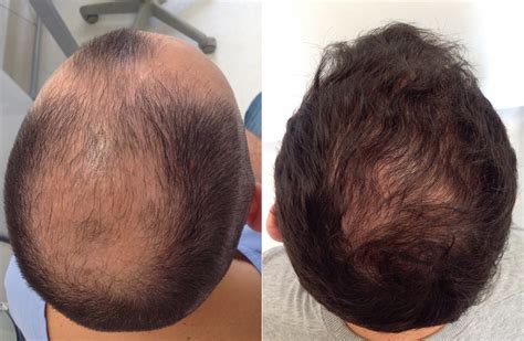 Fue Hair Transplant Before And After Crown Ik Clinics