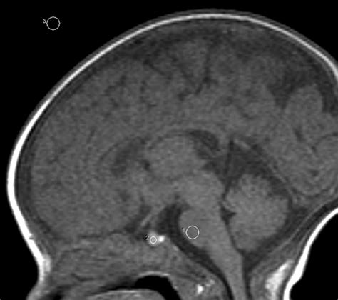 Pituitary Gland Mri