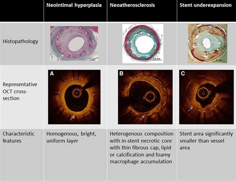 Restenosis Of Drug Eluting Stents Circulation Cardiovascular