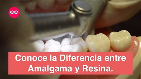 Amalgama vs Resina Consulta médica YouTube