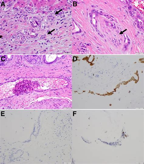 Highly Invasive Behavior And Immunohistochemistry Of Intrahepatic Download Scientific Diagram