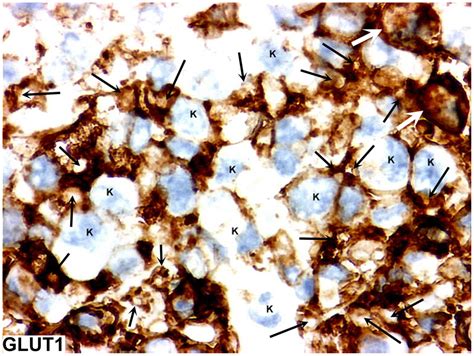 GLUT1 expression in RTAMs. Original magnification: ×200. GLUT1 ...