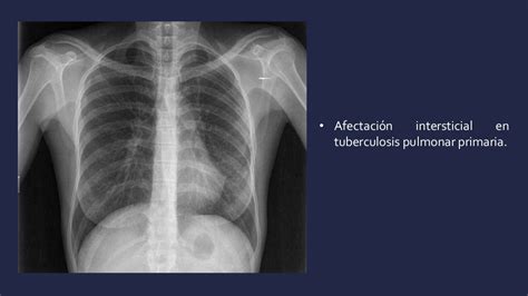 Tuberculosis Pulmonar En La Radiografía De Tórax