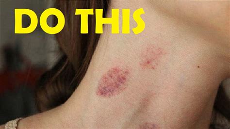 How To Get Rid Of A Hickey In Seconds Remove A Hickey Fast Youtube