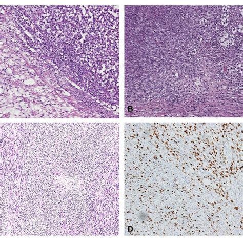 Principal Component Analysis Of Seminoma Mixed Germ Cell Tumors And Download Scientific