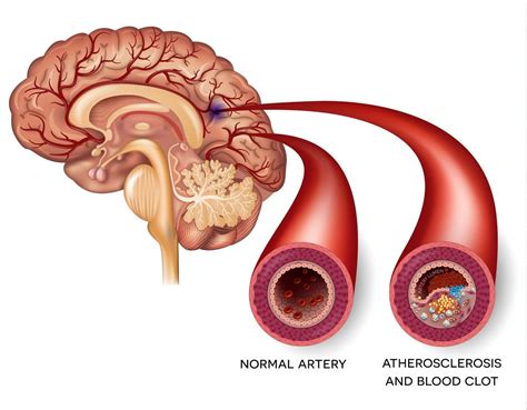 Atherosclerosis impact on cognitive function