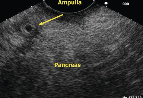 Eus Of The Normal Pancreas Radiology Key