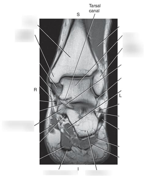 Ankle Coronal 2 Diagram Quizlet