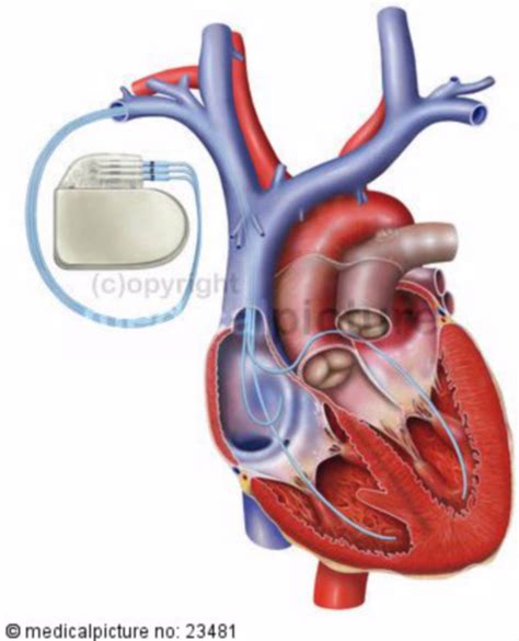 Herz Mit Schrittmacher DocCheck