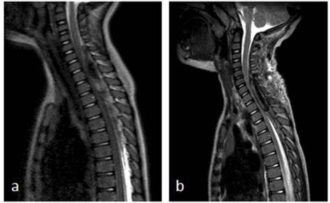 A Sagittal T2 MRI Images Show Cervical Spinal Epidural Hematoma