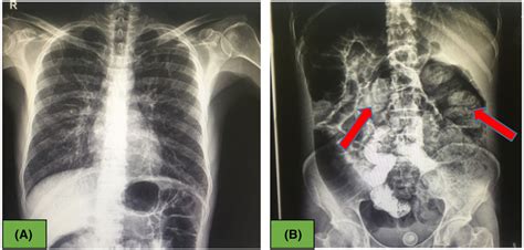 (A) Normal chest X‐ray, (B) Abdominal x‐ray showed fecal impaction in ...