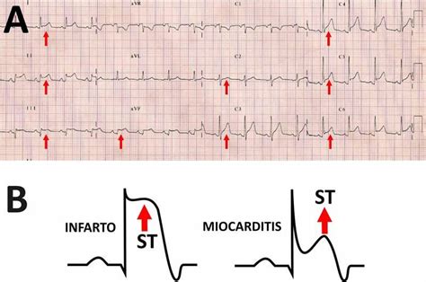 Ber Pericarditis Ekg | www.imagenesmy.com