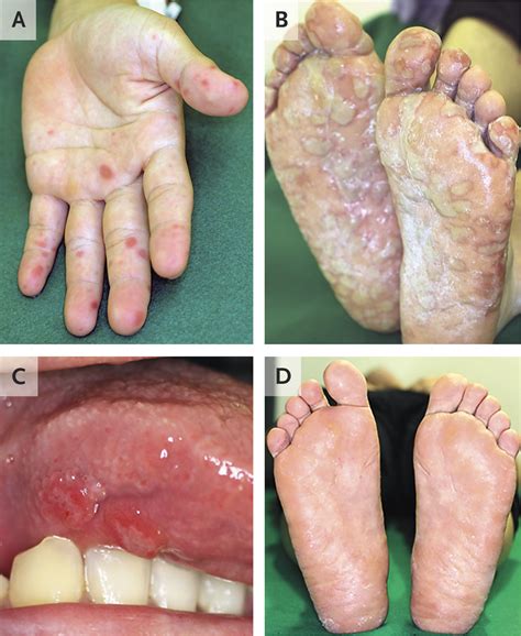 Hand Foot And Mouth Disease Hfmd Human Hand Of Scarlet Fever On Palm