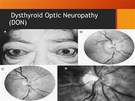 Thyroid Ophthalmopathy