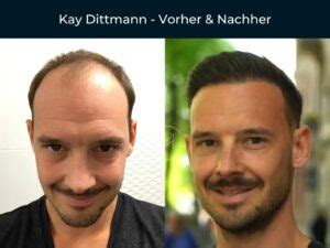 Promis Mit Haartransplantation Vorher Nachher Vorher Nachher