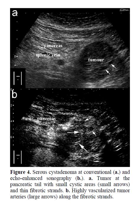 Pancreatic Adenocarcinoma Ultrasound