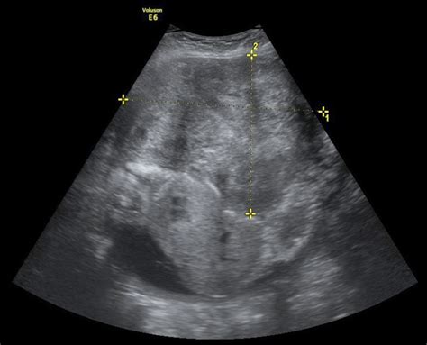 Puerperal Complications Of A Retroplacental Uterine Leiomyoma