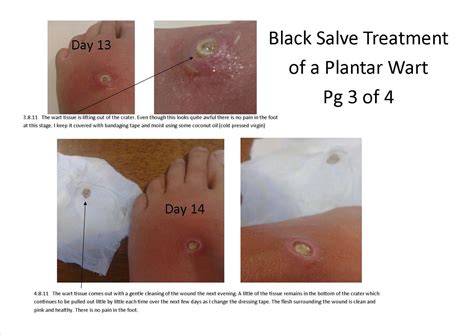 Holistic Therapy Connections: Treatment of a Plantar Wart using Black Salve