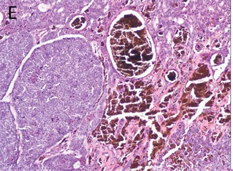 A A Nodular Well Circumscribed Basophilic Tumor Involved The Dermis