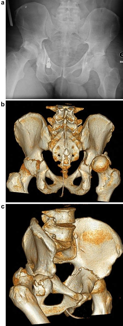 Anteroposterior Pelvis Radiograph A And Posterior B And Oblique C