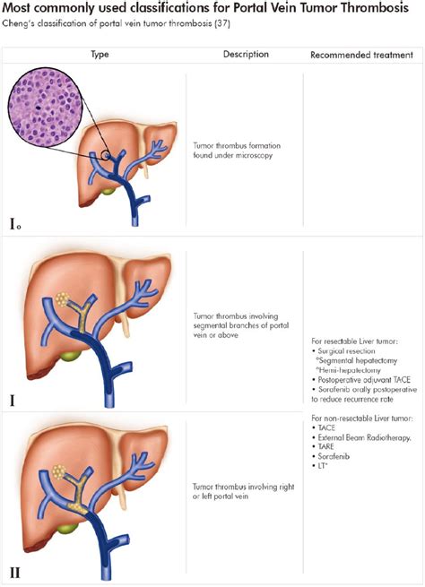 Most Commonly Used Classifications For Portal Vein Tumor Thrombosis Download Scientific Diagram