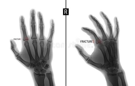 X Ray Of The Hand Shows The Fracture Of The Base Of The Proximal