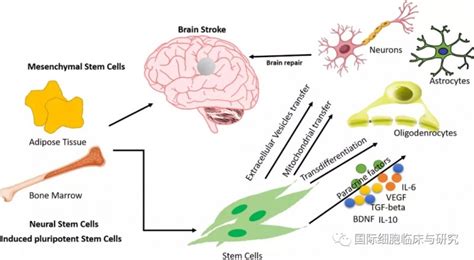 《neurosci》发文干细胞治疗脑卒中干细胞治疗中风的应用全球肿瘤医生网